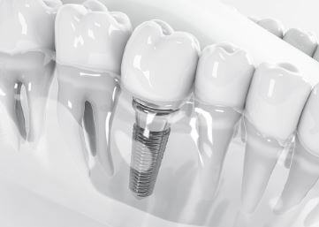 implant